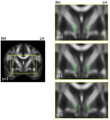 White Matter Changes in Cervical Dystonia Relate to Clinical Effectiveness of Botulinum Toxin Treatment